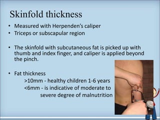 Skinfold thickness
• Measured with Herpenden’s caliper
• Triceps or subscapular region
• The skinfold with subcutaneous fat is picked up with
thumb and index finger, and caliper is applied beyond
the pinch.
• Fat thickness
>10mm - healthy children 1-6 years
<6mm - is indicative of moderate to
severe degree of malnutrition
50
 