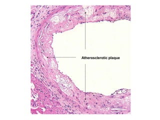 Atherosclerotic plaque
 