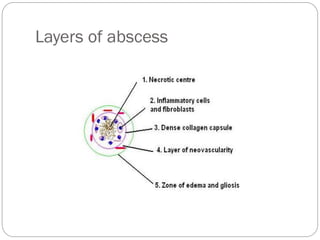 Brain abscess and it course of treatment | PDF