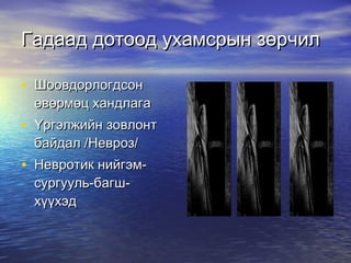 Гадаад дотоод ухамсрын зөрчил Шоовдорлогдсон өвөрмөц хандлага Үргэлжийн зовлонт байдал /Невроз/ Невротик нийгэм-сургууль-багш-хүүхэд 