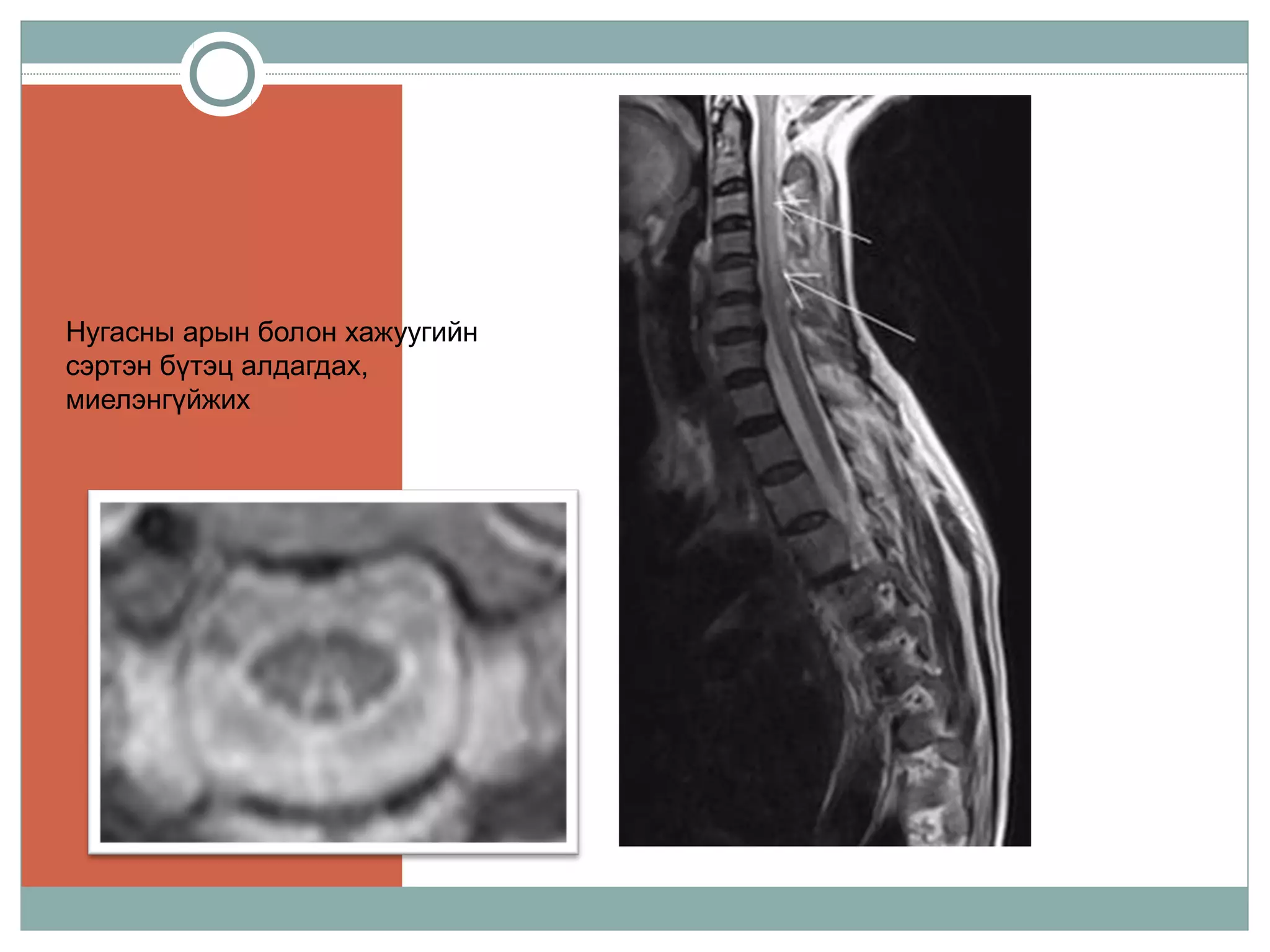 Нугасны арын болон хажуугийн
сэртэн бүтэц алдагдах,
миелэнгүйжих
 