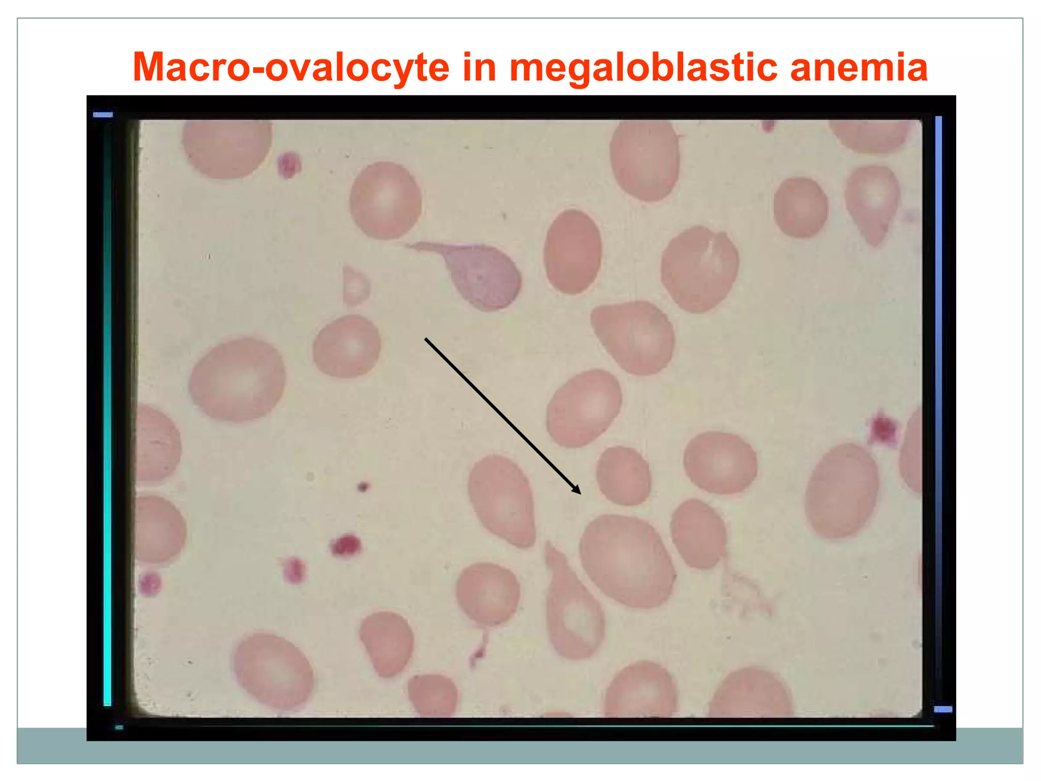 Macro-ovalocyte in megaloblastic anemia
 