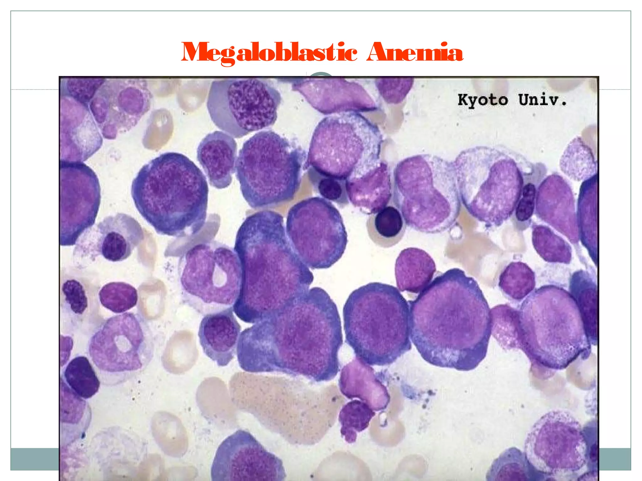 Megaloblastic Anemia
 
