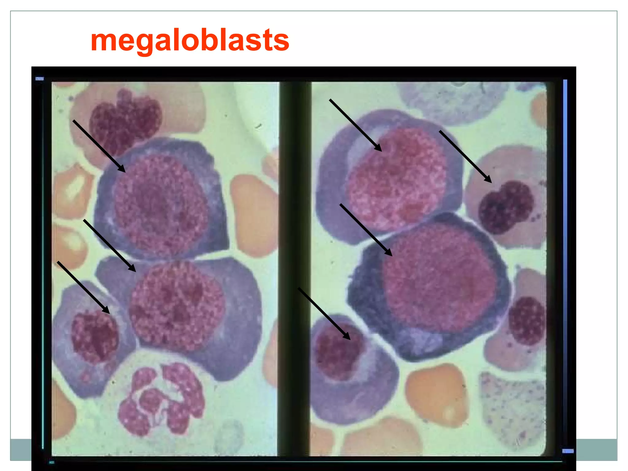 megaloblasts
 