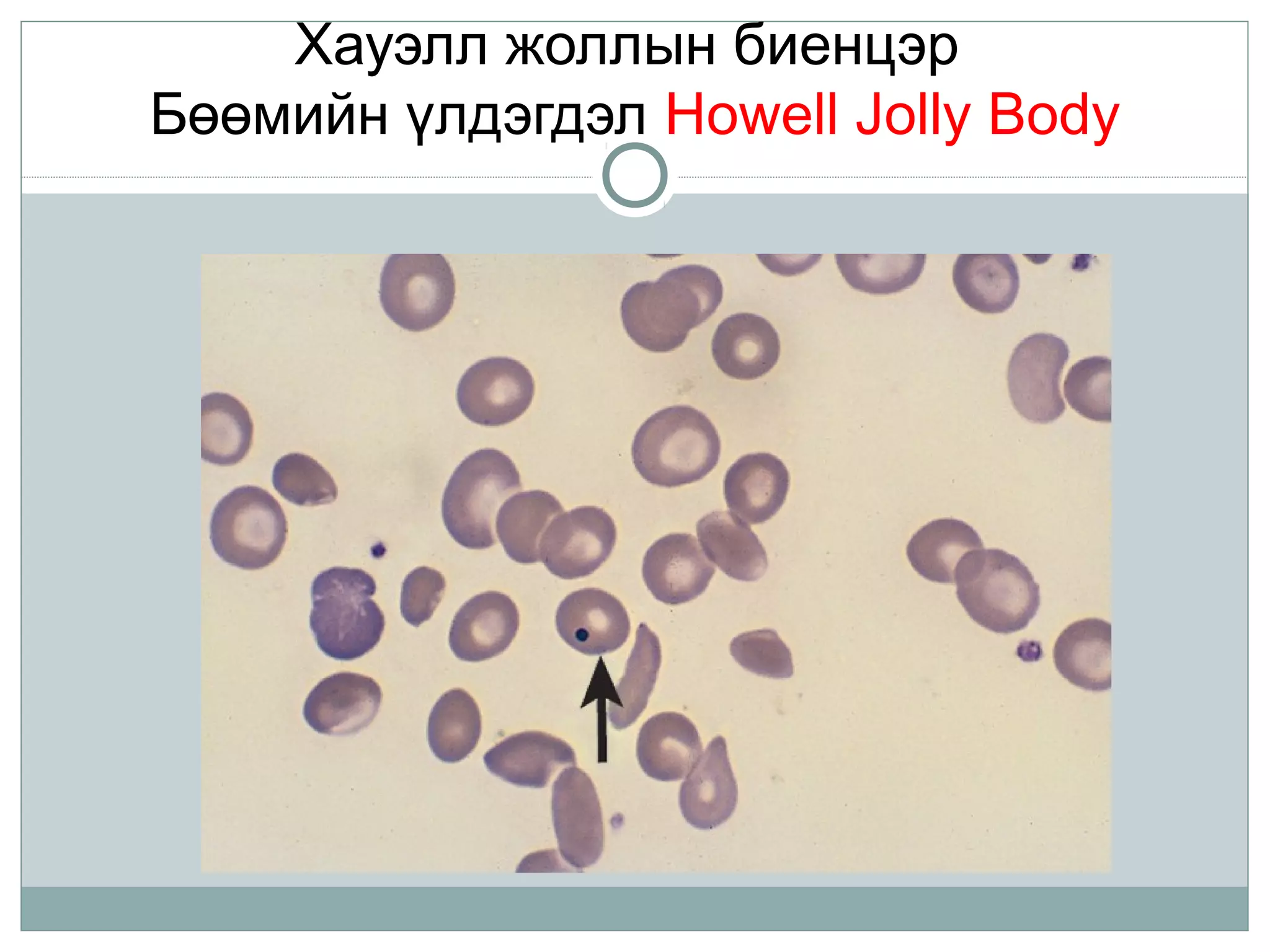 Хауэлл жоллын биенцэр
Бөөмийн үлдэгдэл Howell Jolly Body
 