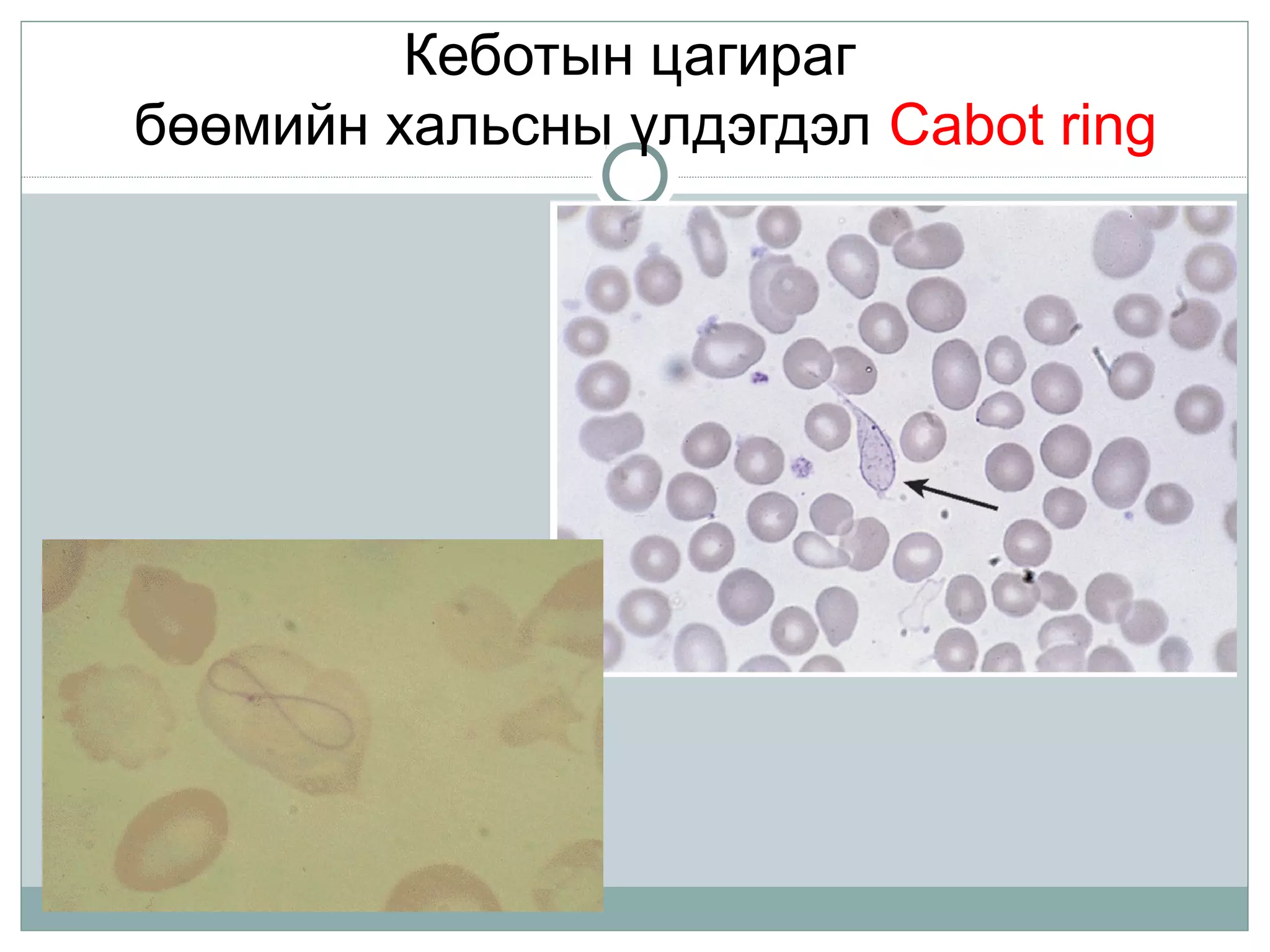 Кеботын цагираг
бөөмийн хальсны үлдэгдэл Cabot ring
 