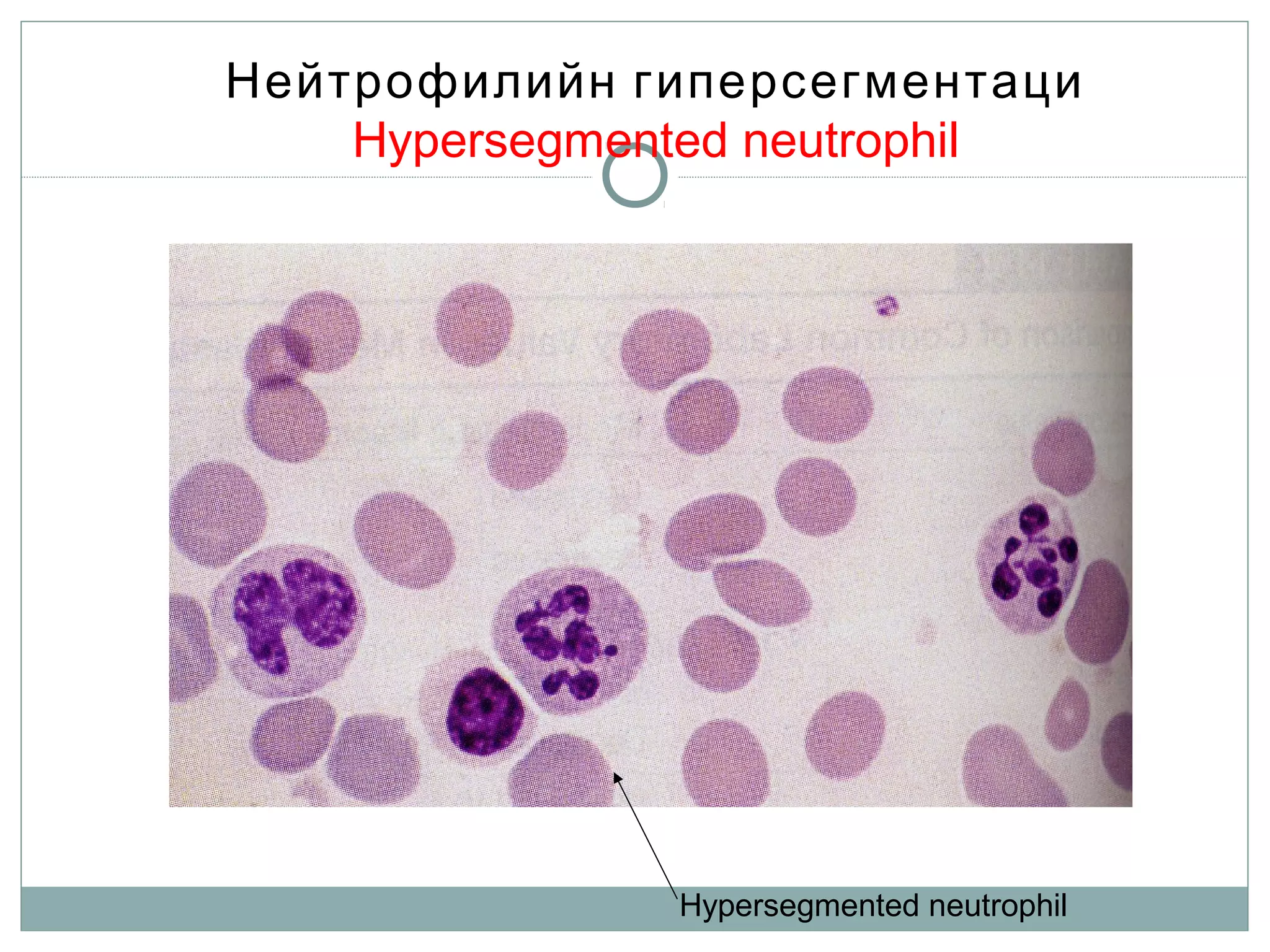 Нейтрофилийн гиперсегментаци
Hypersegmented neutrophil
Hypersegmented neutrophil
 