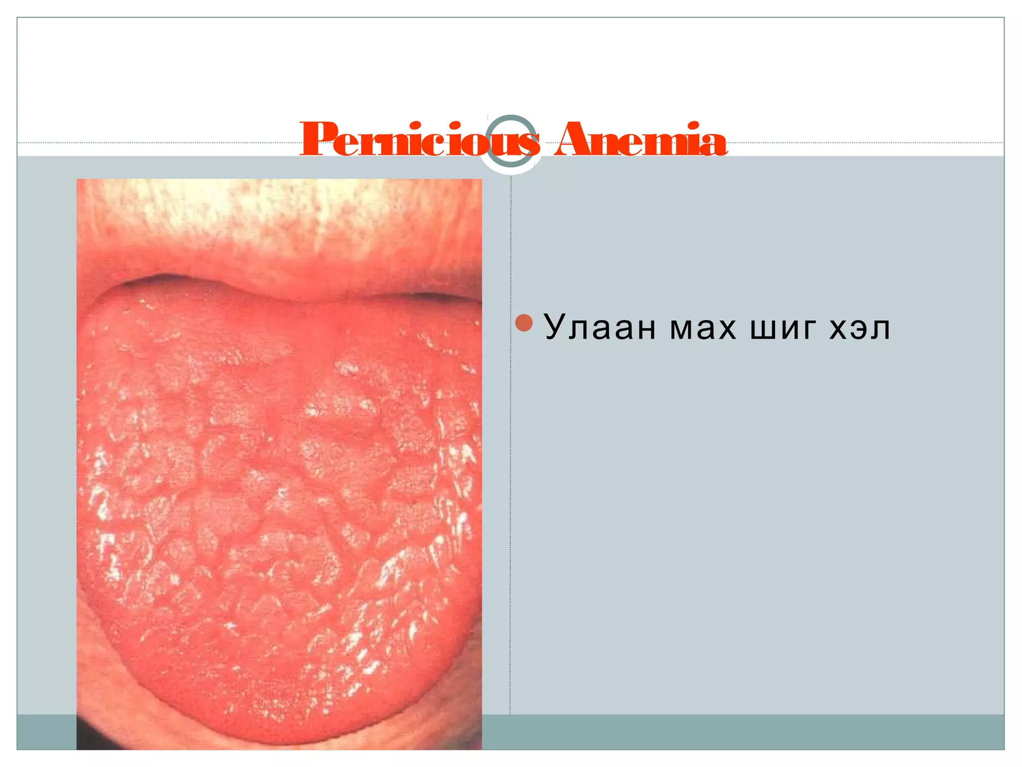 Pernicious Anemia
Улаан мах шиг хэл
 