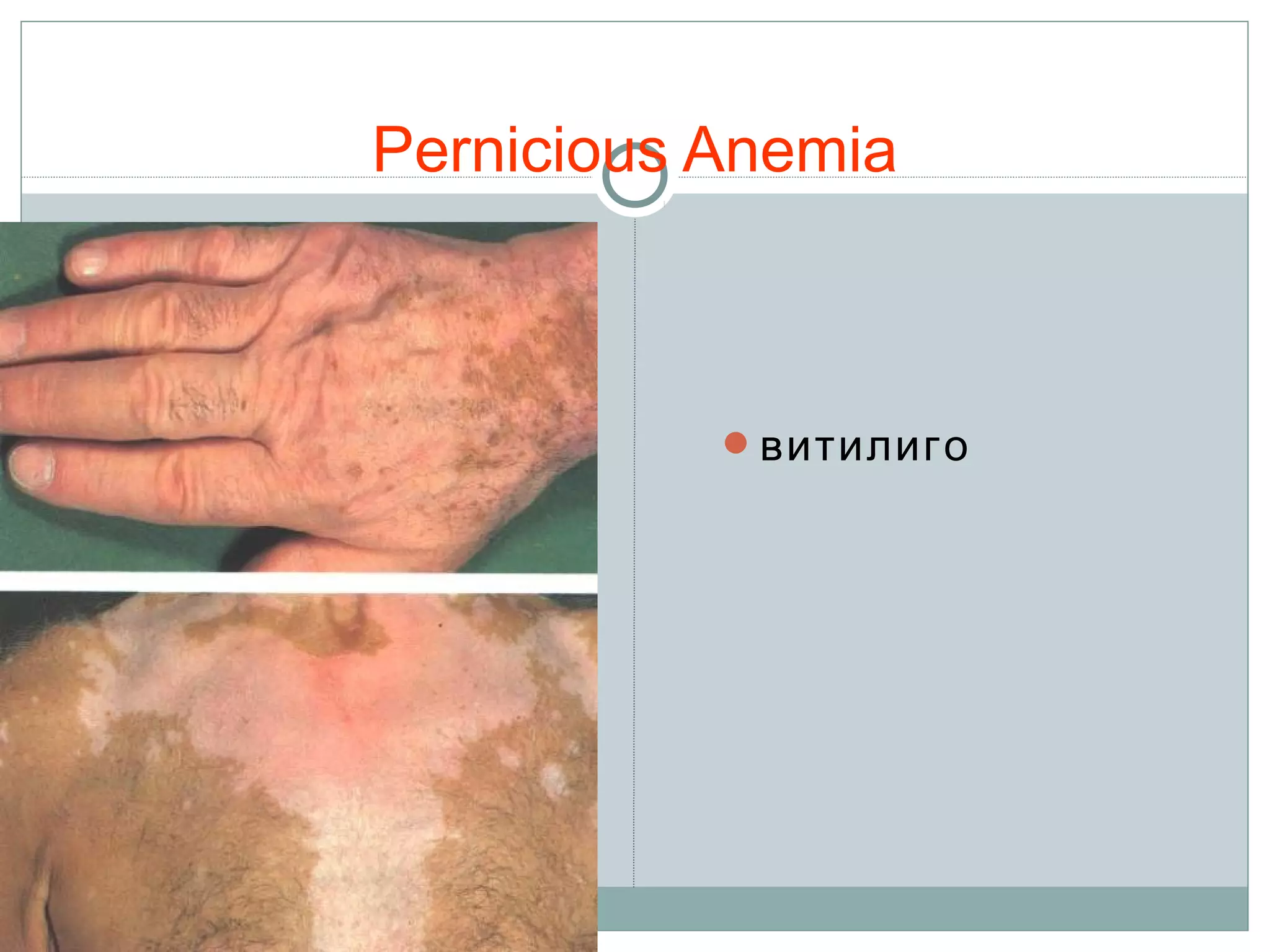 Pernicious Anemia
витилиго
 