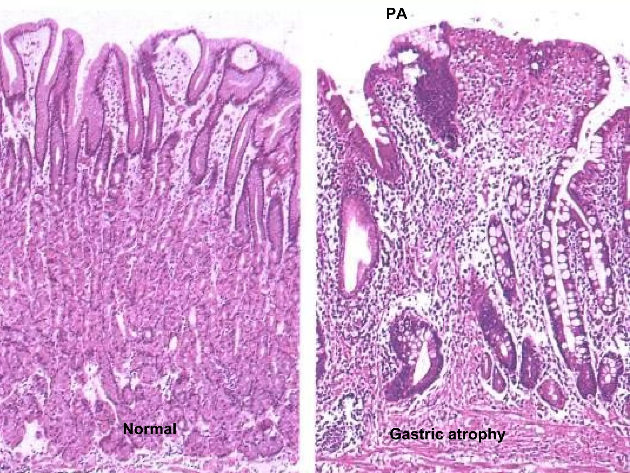 Normal Gastric atrophy
PA
 