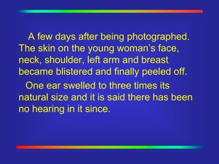 A few days after being photographed.
The skin on the young woman’s face,
neck, shoulder, left arm and breast
became blistered and finally peeled off.
One ear swelled to three times its
natural size and it is said there has been
no hearing in it since.
 