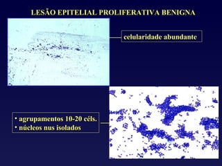 LESÃO EPITELIAL PROLIFERATIVA BENIGNA agrupamentos 10-20 céls. núcleos nus isolados celularidade abundante 