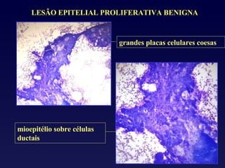 mioepitélio sobre células ductais LESÃO EPITELIAL PROLIFERATIVA BENIGNA grandes placas celulares coesas 