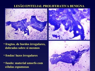 fragtos. de bordos irregulares, dobrados sobre si mesmos fendas/ luzes irregulares fundo: material amorfo com células espumosas LESÃO EPITELIAL PROLIFERATIVA BENIGNA 