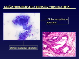 LESÃO PROLIFERATIVA BENIGNA (=HD sem ATIPIA) atipias nucleares discretas células metaplásicas apócrinas 
