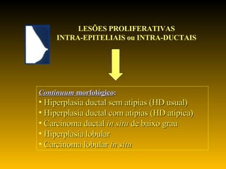 LESÕES PROLIFERATIVAS INTRA-EPITELIAIS ou INTRA-DUCTAIS Continuum  morfológico :  Hiperplasia ductal sem atipias (HD usual) Hiperplasia ductal com atipias (HD atípica) Carcinoma ductal  in situ  de baixo grau Hiperplasia lobular Carcinoma lobular  in situ 
