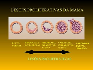 LESÕES PROLIFERATIVAS DA MAMA LESÕES PROLIFERATIVAS DUCTO NORMAL HIPERPLASIA INTRADUCTAL HIPERPLASIA INRADUCTAL ATÍPICA CARCINOMA INTRADUCTAL IN SITU CARCINOMA DUCTAL INVASIVO 