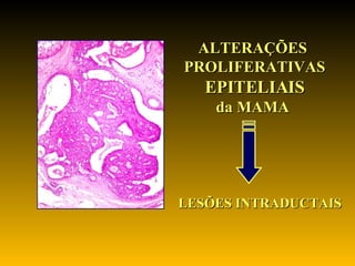 ALTERAÇÕES  PROLIFERATIVAS EPITELIAIS da MAMA  LESÕES INTRADUCTAIS 