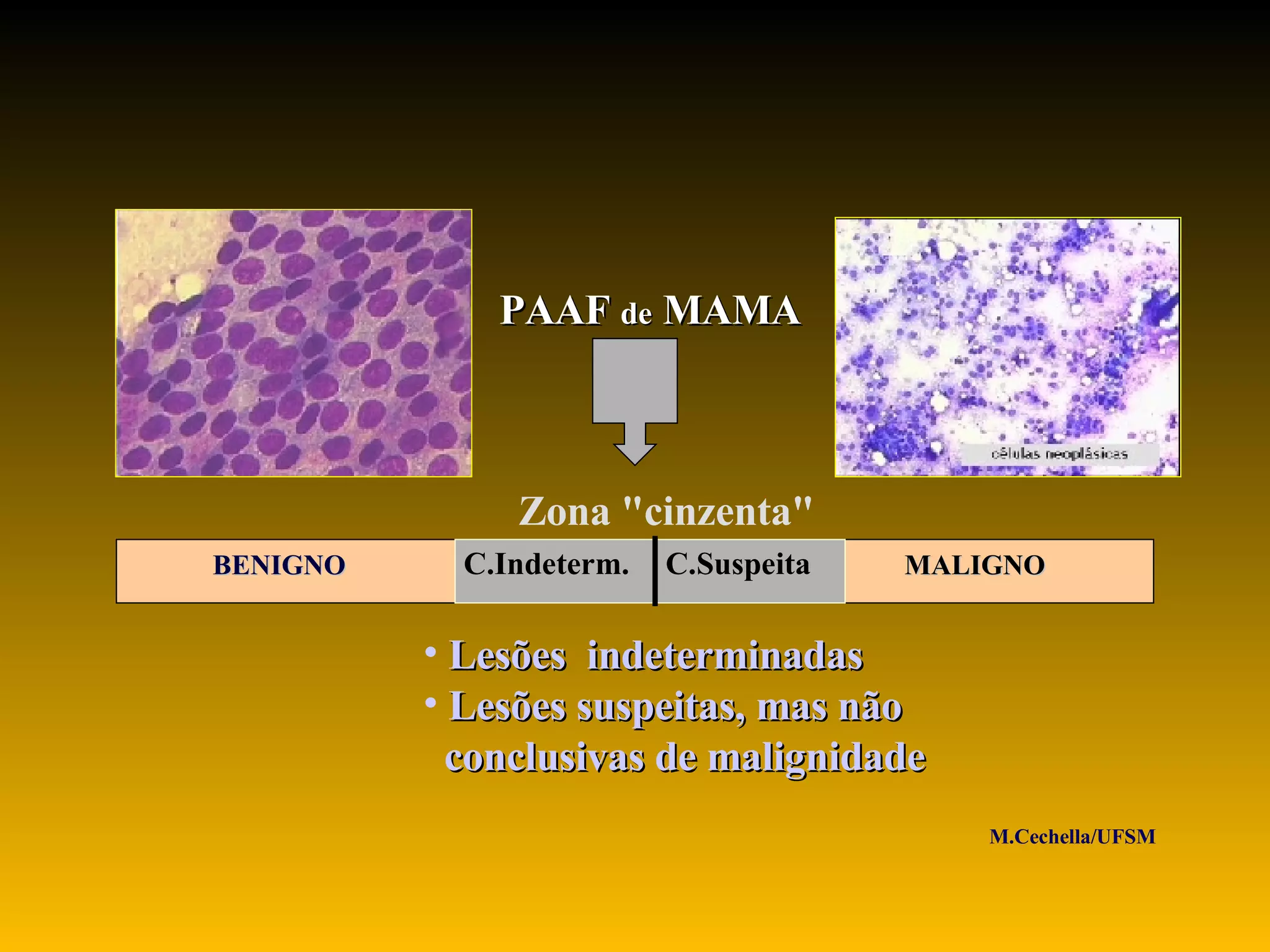 Paaf Citopatologia Mamaria - Zona Cinzenta em PAAF de mama: Lesoes ...