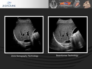 Zone Sonography Technology   Beamformer Technology
 