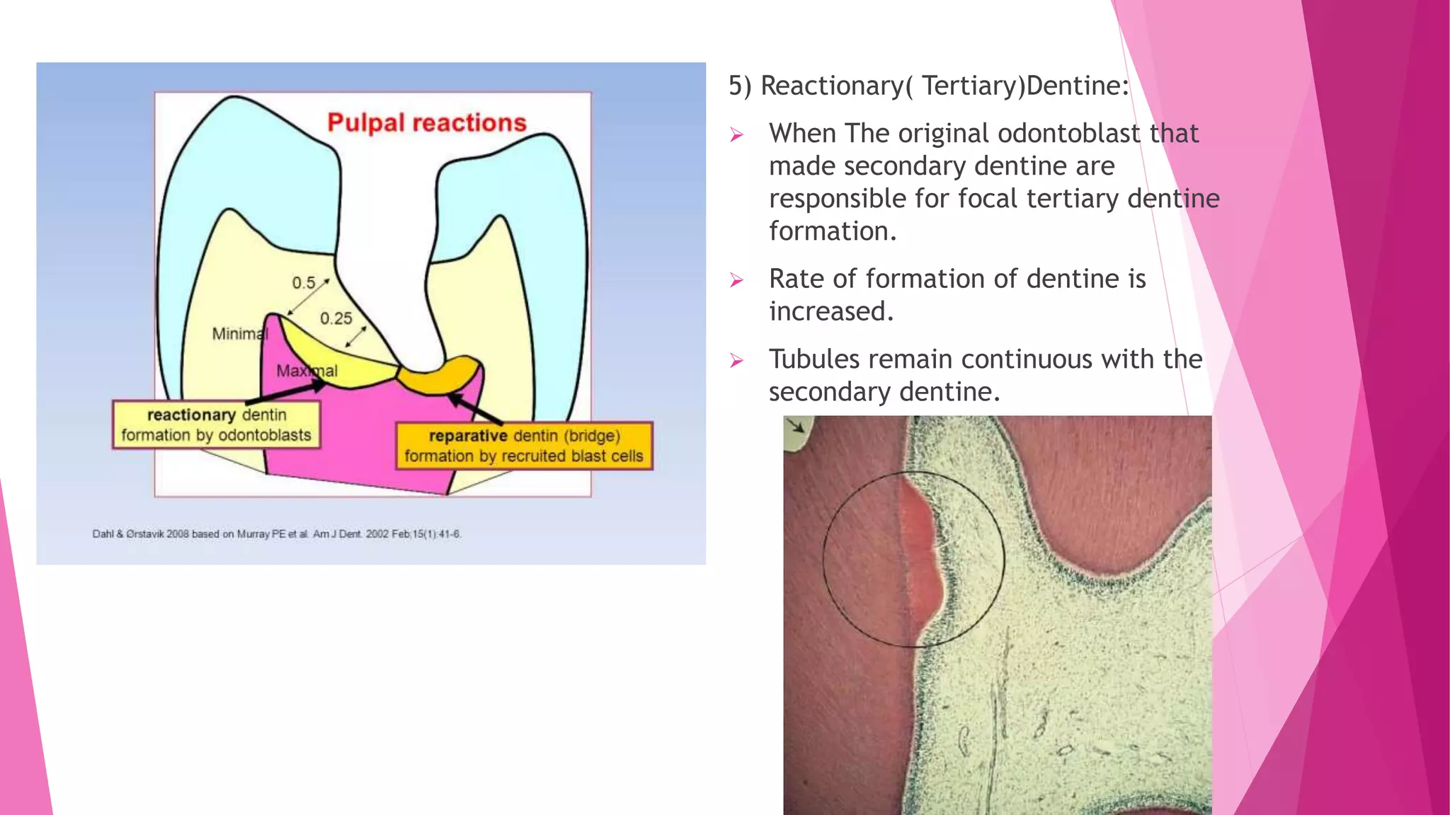 Zones of enamel and dentinal caries completed | PPTX
