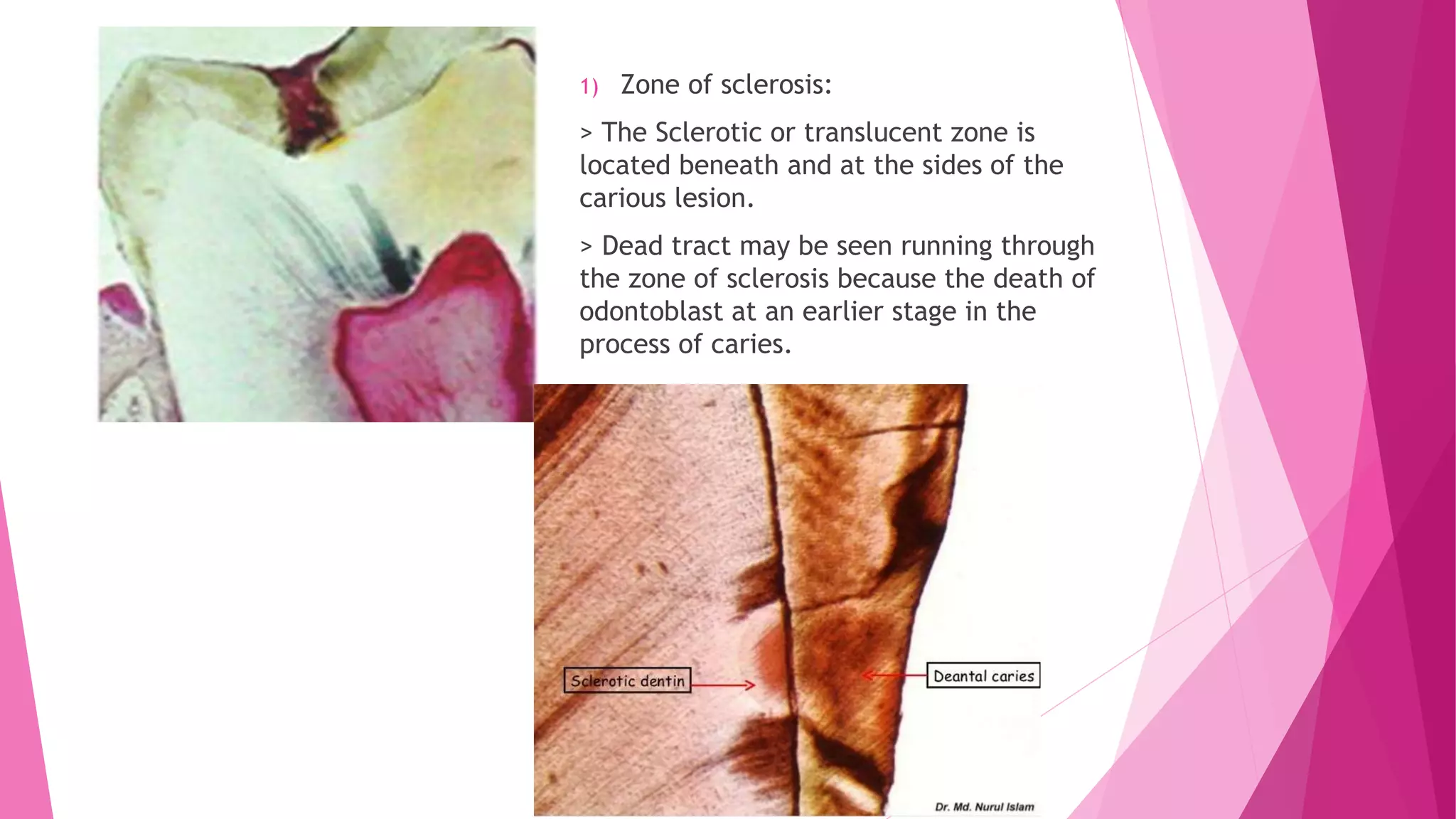 Translucent Dentin Zones of enamel and dentinal caries completed | PPTX