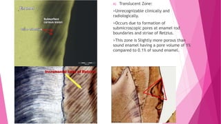 Zones of enamel and dentinal caries completed | PPTX