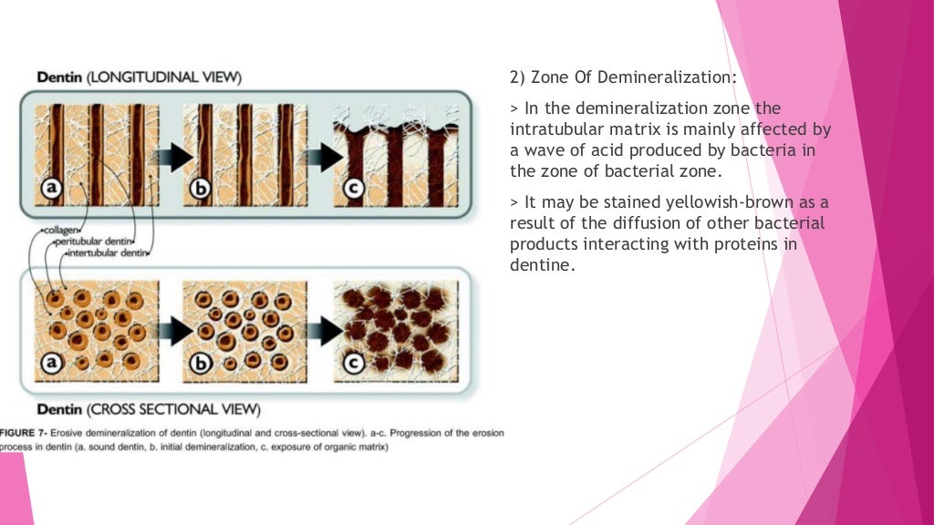 Zones of enamel and dentinal caries completed