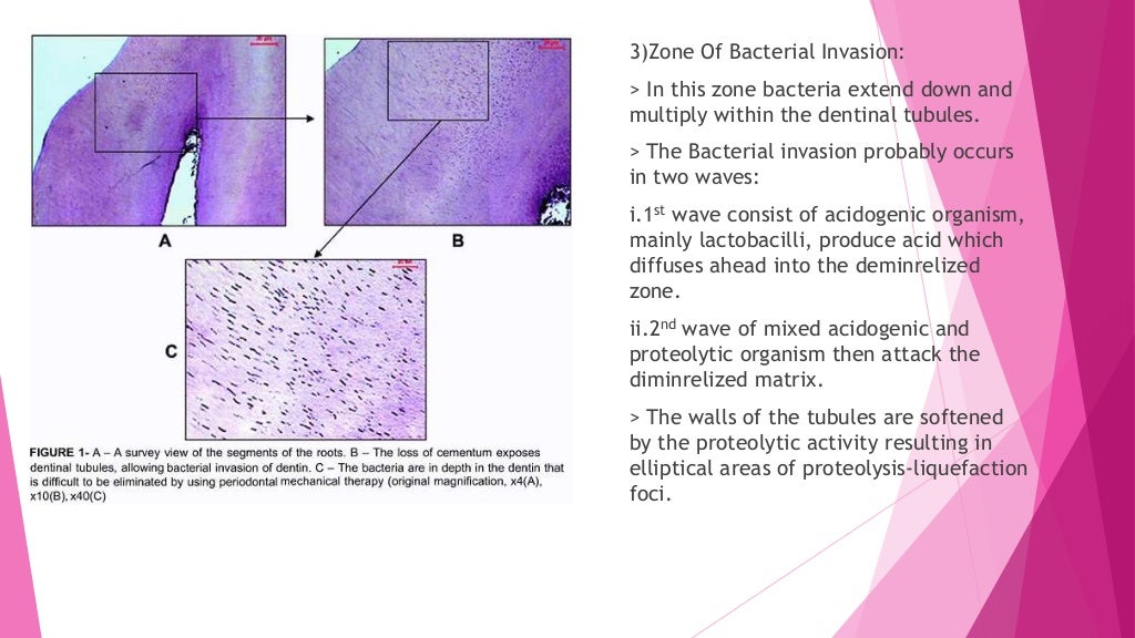 Zones of enamel and dentinal caries completed