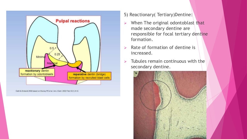 Zones of enamel and dentinal caries completed