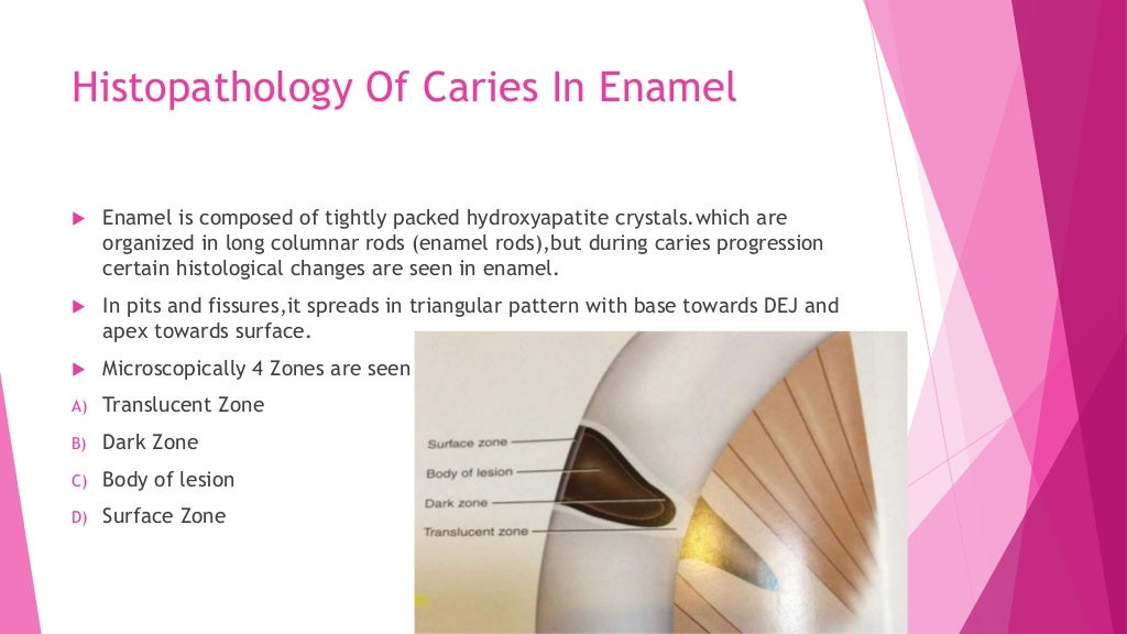 Zones of enamel and dentinal caries completed