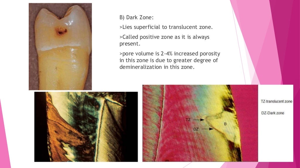 Zones of enamel and dentinal caries completed