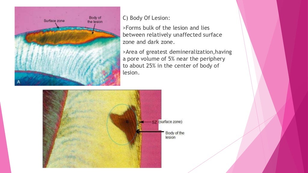 Zones of enamel and dentinal caries completed
