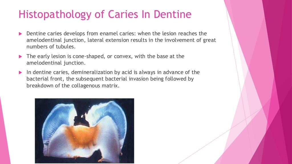 Zones of enamel and dentinal caries completed