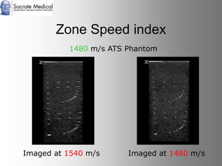 Socrate Medical presenta Zone Sonography, by Zonare
