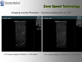 Socrate Medical presenta Zone Sonography, by Zonare