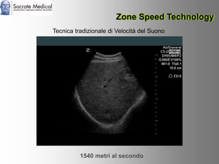 Socrate Medical presenta Zone Sonography, by Zonare