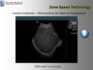Socrate Medical presenta Zone Sonography, by Zonare