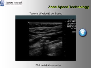 Socrate Medical presenta Zone Sonography, by Zonare