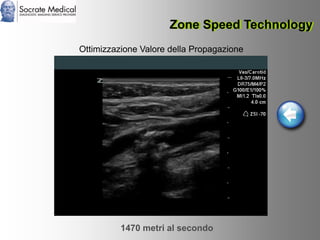 Socrate Medical presenta Zone Sonography, by Zonare