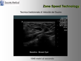 Socrate Medical presenta Zone Sonography, by Zonare