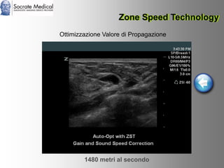 Socrate Medical presenta Zone Sonography, by Zonare