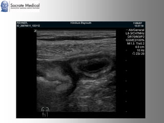 Socrate Medical presenta Zone Sonography, by Zonare
