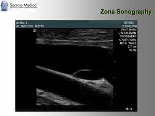 Socrate Medical presenta Zone Sonography, by Zonare
