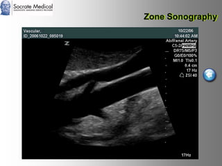 Socrate Medical presenta Zone Sonography, by Zonare