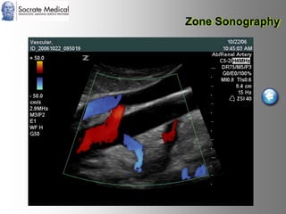 Socrate Medical presenta Zone Sonography, by Zonare