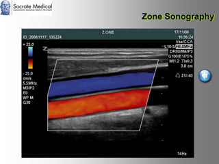 Socrate Medical presenta Zone Sonography, by Zonare