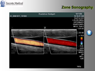 Socrate Medical presenta Zone Sonography, by Zonare