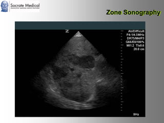 Socrate Medical presenta Zone Sonography, by Zonare