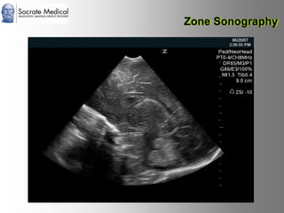 Socrate Medical presenta Zone Sonography, by Zonare